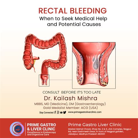 What Is Rectal Bleeding Causes Symptoms Treatment And More