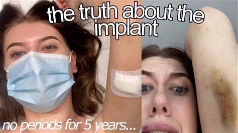getting my implant removed and replaced after 5 years my experience youtube
