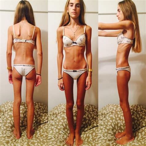Tuvo Anorexia A Los Y Su Relato Se Volvi Viral Mi Cuerpo Me Ped A