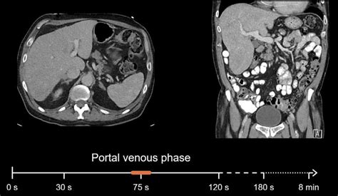 Abdominal Ct Phases 2023