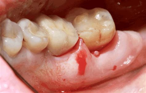 Gingival Solitary Neurofibroma Mind The Pitfalls A Case Report