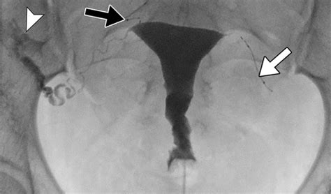 Evaluating Fallopian Tube Patency What The Radiologist Needs To Know