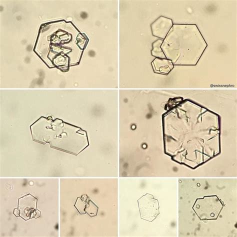 What Are The Types Of Crystals Found In Urine