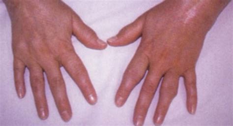 Symptômes De La Polyarthrite Rhumatoïde Rhumaguide