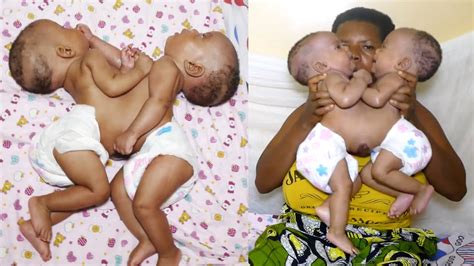 The Incredible Conjoined Twins Born As One Born Different Youtube