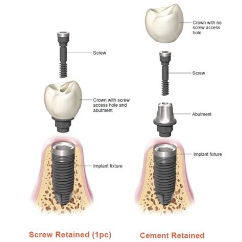 Bonding The Implant Crowns Dent Smile