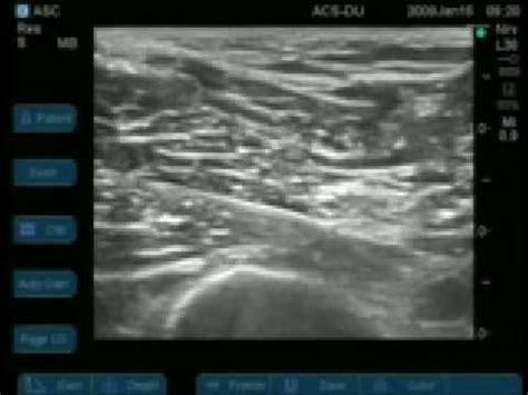 Because of its deep location in the gluteal region and proximal thigh, it is often challenging to visualize this nerve with ultrasound. Ultrasound Guided Popliteal Sciatic Nerve Block - YouTube