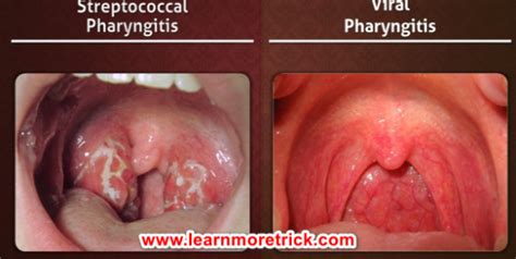 Ent Sore Throat Throat Infection Pharyngitis Learn More
