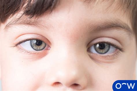 Lazy Eye Amblyopia Causes Symptoms Diagnosis And Treatment