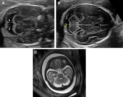 Ultrasound And Mr Imaging Of The Normal Fetal Brain Neuroimaging Clinics