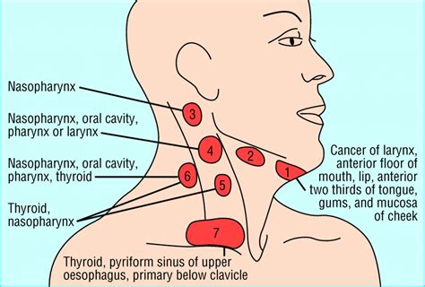 Management Of Lateral Neck Masses In Adults The Bmj