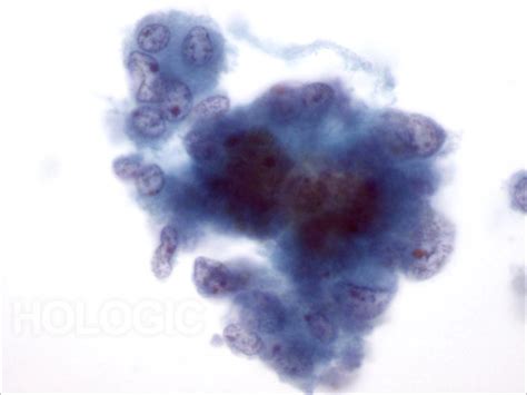 Pheochromocytoma Adrenal Gland Cytology