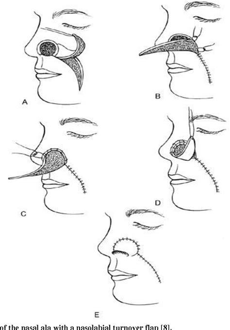 Figure From Reconstruction Of The Nasal Defects By Nasolabial Flaps