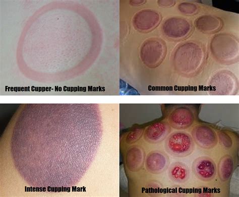 Now under the skin where the. Cupping Marks, Are They Bruises? A Scientific Review |www ...