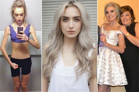 Anorexia Sufferer Who Ate Just 400 Calories A Day Makes Incredible