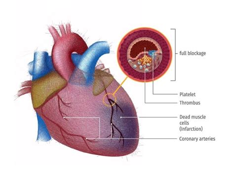 An Illustration Of Myocardial Infarction Download Scientific Diagram