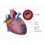 An Illustration Of Myocardial Infarction  Download Scientific Diagram