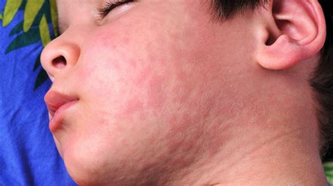 Skin Allergies And Urticaria Sparsh Skin Clinic