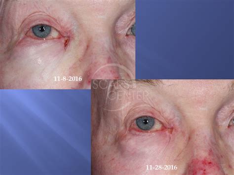 Medial Canthus Basal Cell Carcinoma Follow Up Skin Cancer And