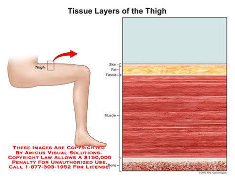 Diagram of an injured leg and joint. layers - Anatomy Exhibits