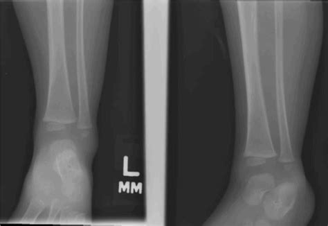 An Updated Approach To Toddler Fractures Journal Of Urgent Care Medicine