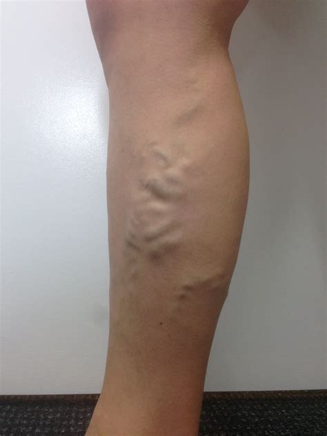 Varicose Vein Results And Post Treatment Photos — The Leg Vein Doctor