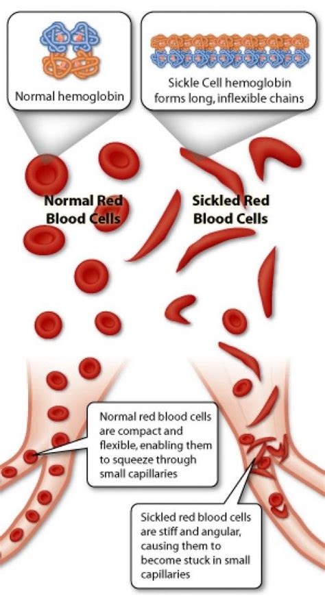Sickle Cell Disease Sickle Cell Anemia Sickle Cell Sickle Cell