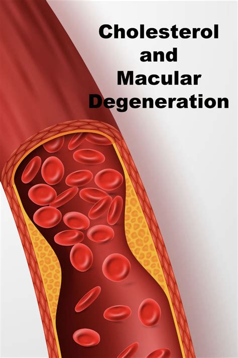 Cholesterol and Macular Degeneration in 2021 | Macular degeneration ...