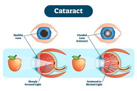 Treatment For Congenital Cataracts Kids Eye Gear