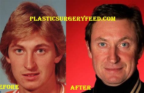 Wayne Gretzky Plastic Surgery Plastic Surgery Feed