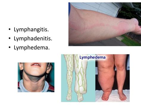 Ppt Venous Drainage And Lymphatics Of The Upper Limb Powerpoint