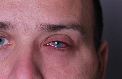 How To Get Rid Of Bloodshot Eyes 6 Tips To Alleviate Irritated Red