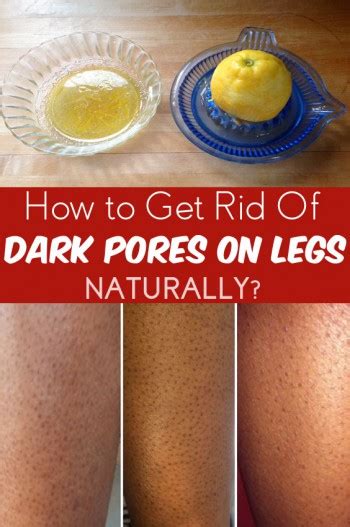 How To Get Rid Of Dark Pores On Legs 9 Fast And Natural Methods Included