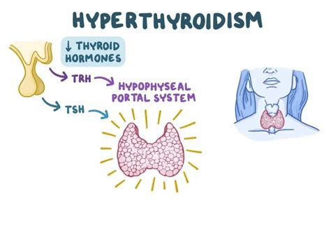Graves Disease Vs Hyperthyroidism Are They The Same Thyroid Aid