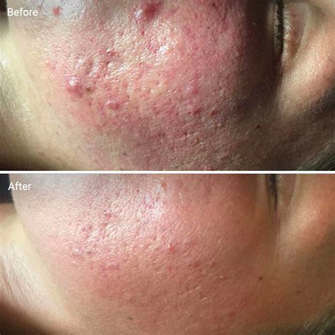 Microdermabrasion For Acne Scars How It Works Benefits Efficacy And Cost