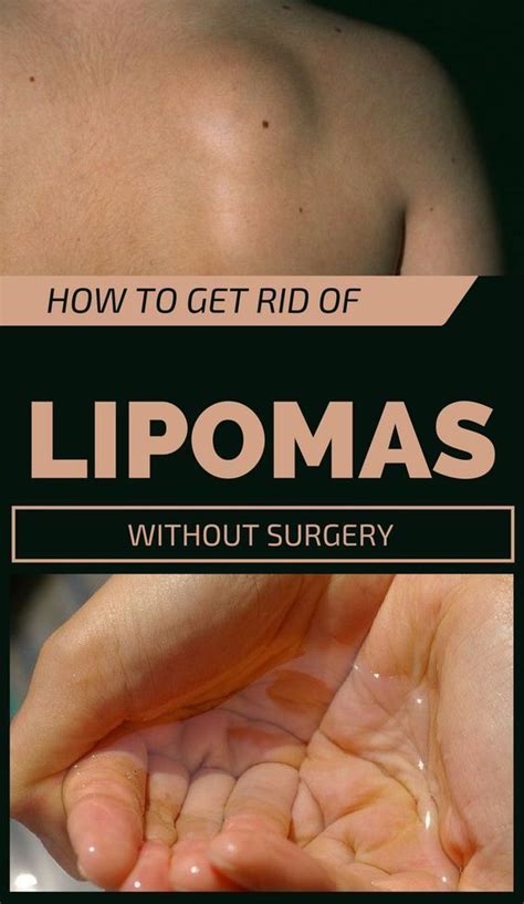 How To Get Rid Of Lipomas Without Surgery With