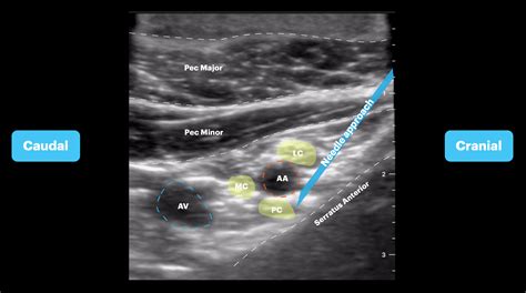 Brachial Plexus Upper Extremity Nerve Blocks Image Atlas — Tpa