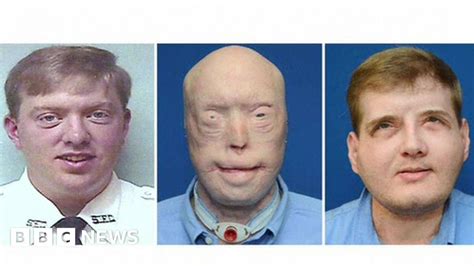 Face Transplant Patient Now I Have Hope Bbc News