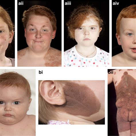 Clinical Images Of Children With Congenital Melanocytic Nevi Cmn