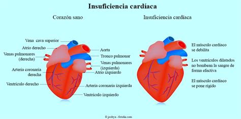 Insuficiencia Cardíaca Clasificación Causas Y Síntomas