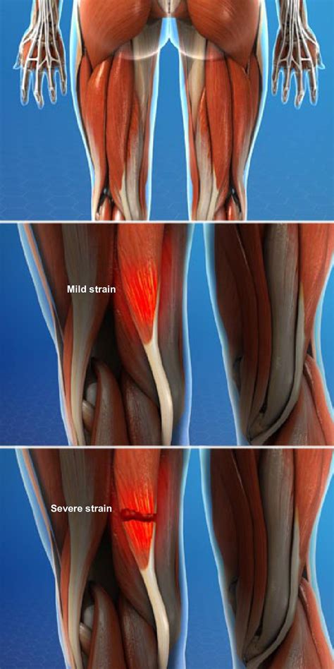 Muscle Strain Injuries Of The Thigh