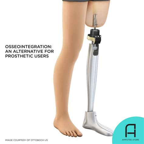 Osseointegration An Alternative For Prosthetic Users Amputee Store