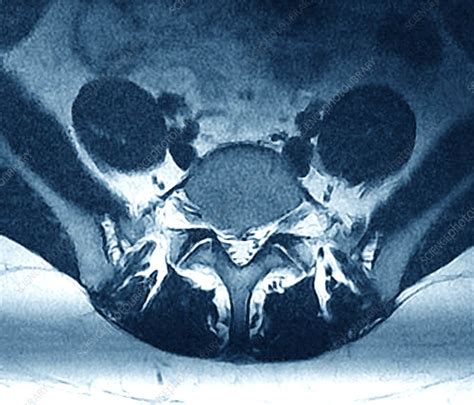 Herniated Disk In Sciatica Mri Stock Image C0479238 Science