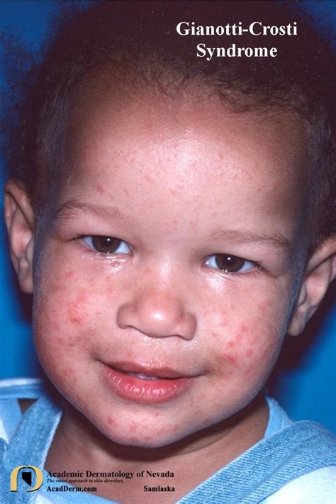 Gianotti Crosti Syndrome Papular Acrodermatitis Of Childhood