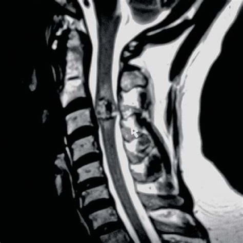 Postoperative Sagittal T2 Weighted Mri Of The Cervical Spine Showing