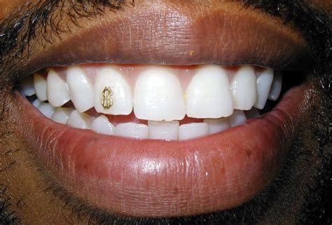 Grillz Yellow Gold Dollarsign Tooth Jewel On Tooth Spiderbite