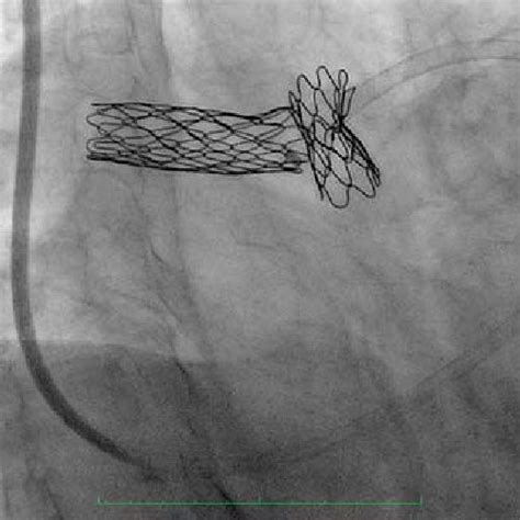 A Pulmonary Angiogram Demonstrated Appropriate Placement Of The Stent