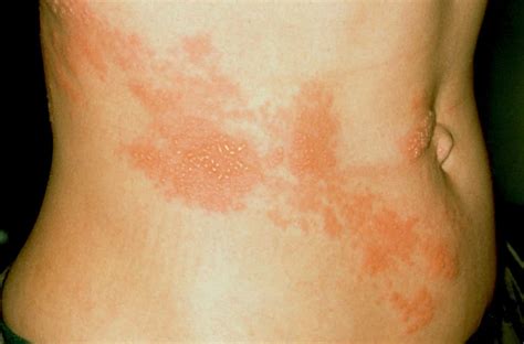What Is Shingles Symptoms And Treatment 🩺 Florida Independent