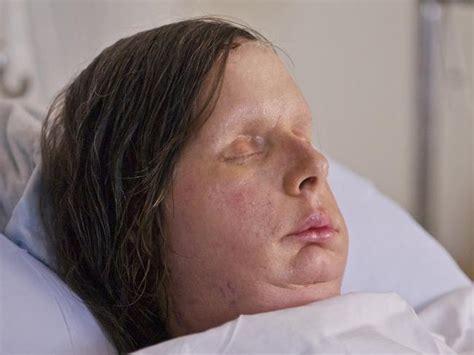 Chimp Victim Charla Nash Returns To Hospital With Face Transplant