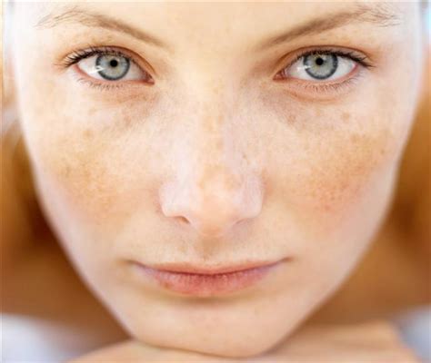 How To Deal With Those Annoying Sunspots On Your Skin New Health Advisor